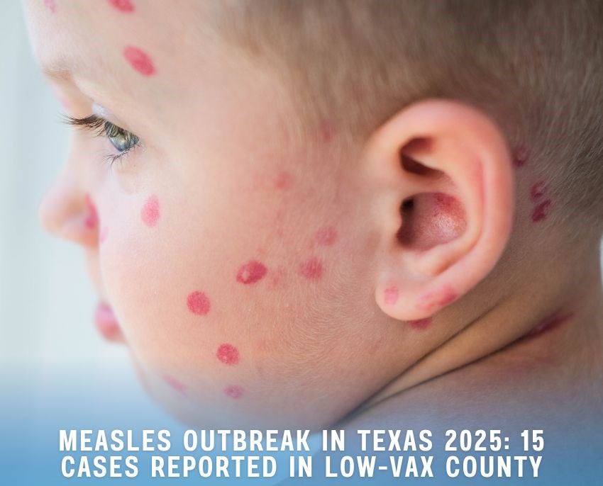 Measles Outbreak in Texas 2025 15 Cases Reported in LowVax County