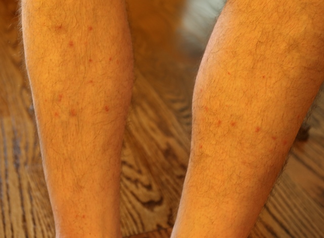 Flea bites on Tim Hollinden leg